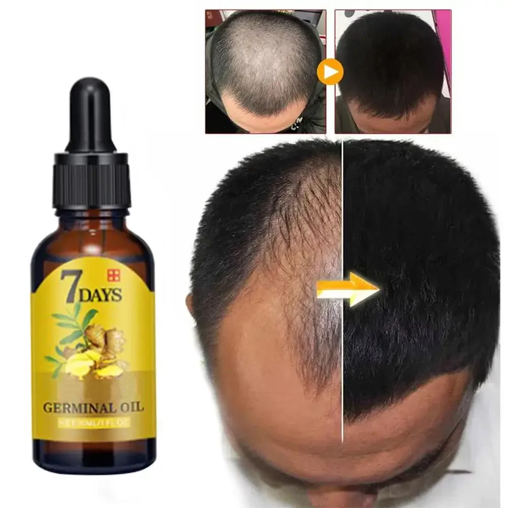 Hair Care Essence Oil Spray - Crescimento do cabelo gengibre rápido crescimento